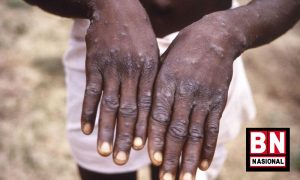 Cacar Monyet Who 300x180