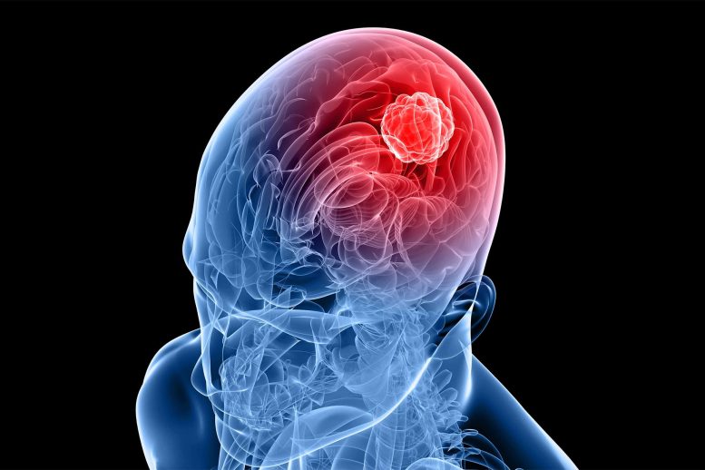 Ilustrasi Tumor Kanker Otak