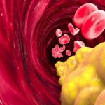 Penyakit Jantung Arteri Pembentukan Kolesterol