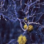 Neuron penyakit Alzheimer dengan plak amiloid