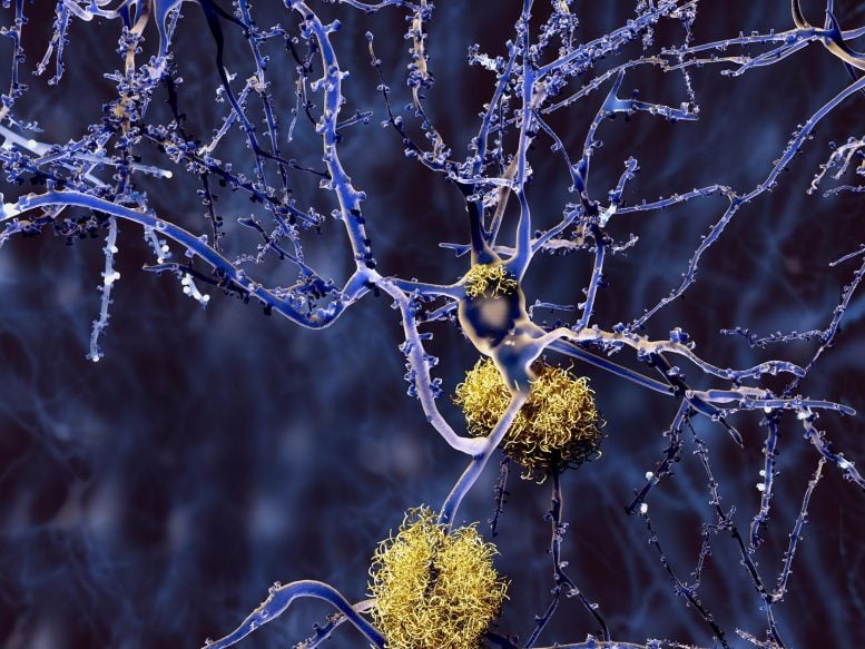 Neuron penyakit Alzheimer dengan plak amiloid