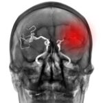 CT scan otak stroke berdarah
