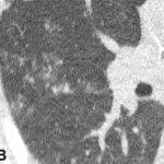 Dada Non-Contrast CT Lung Window Images pada peserta pria berusia 70 tahun