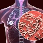 Ilustrasi anatomi tuberkulosis paru yang besar