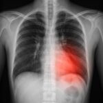 Konsep Seni Penyakit Paru X Ray