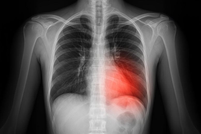 Konsep Seni Penyakit Paru X Ray