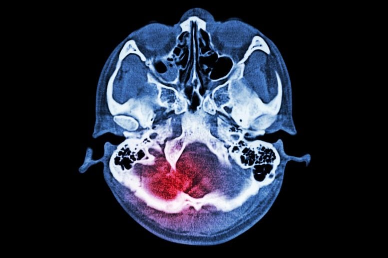 Stroke cedera otak