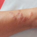 Cacing parasit di bawah kulit manusia