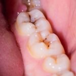 Gigi rongga gigi mengunyah gigi