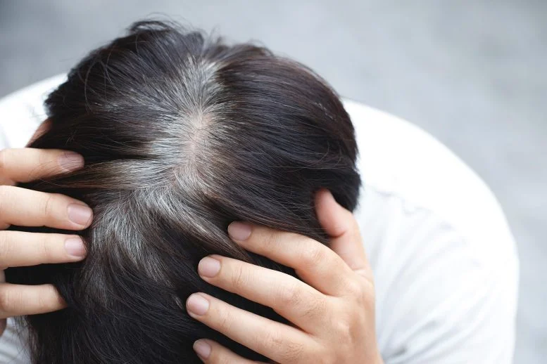 Rambut Beruban Prematur