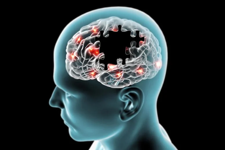 Potongan Puzzle Otak yang Hilang Penyakit Degeneratif Alzheimer Parkinson