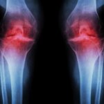 Osteoartritis Lutut