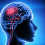 Pembuluh Darah Tumor Kanker Otak Kepala Manusia 3D