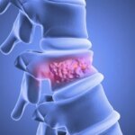 Semen Tulang Stabilisasi Vertebroplasti Tulang Belakang