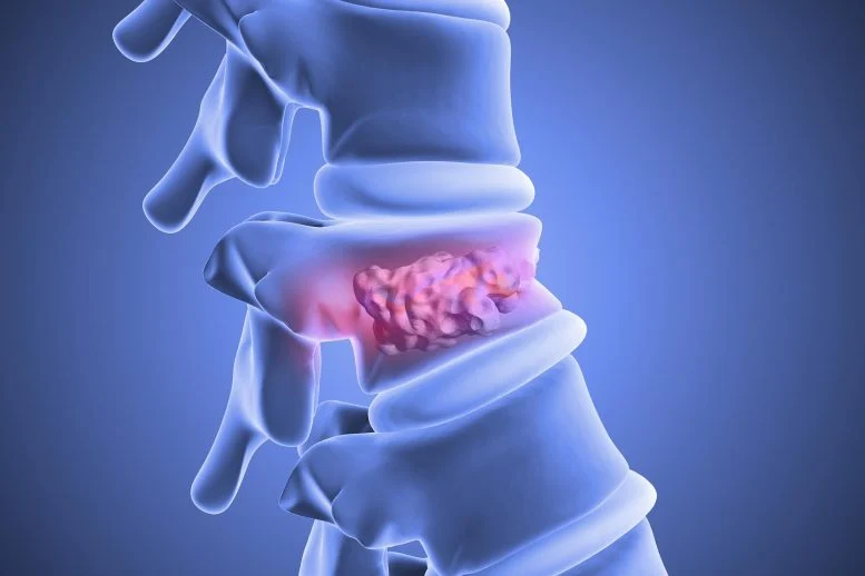 Semen Tulang Stabilisasi Vertebroplasti Tulang Belakang