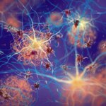 Plak Amiloid Neuron Demensia Alzheimer